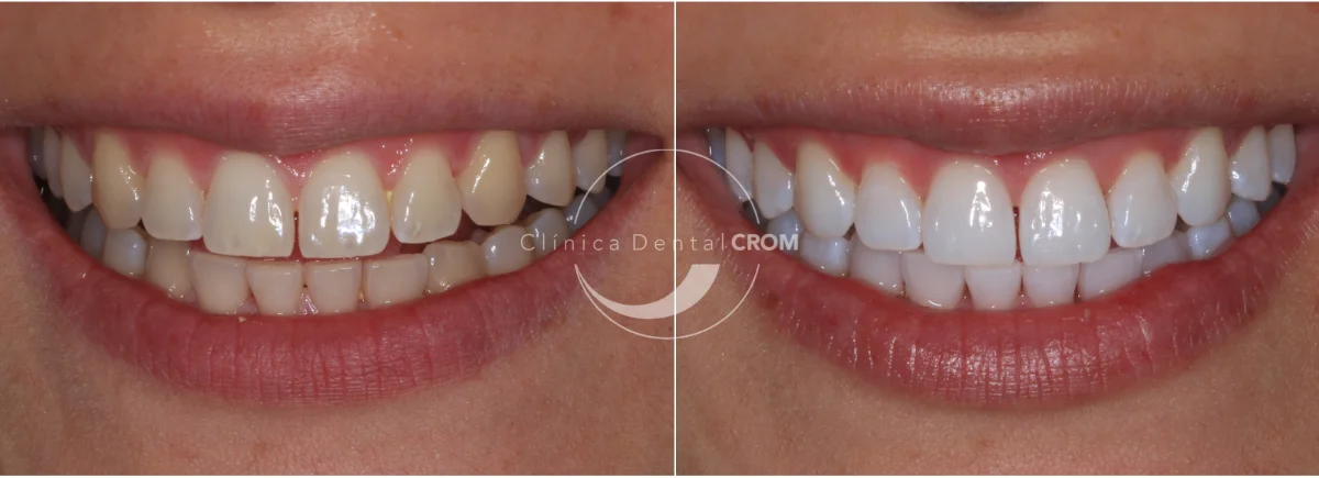 antes-y-despues-5